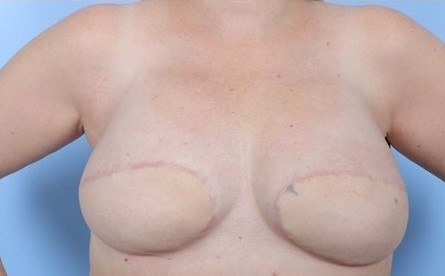 After Image: Patient 1 - front