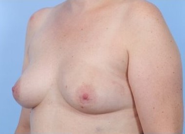 Before Image: Patient 1 - left-front-oblique