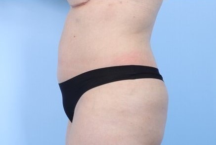 After Image: Patient 1 - left-side
