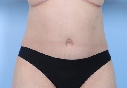 After Image: Patient 1 - front