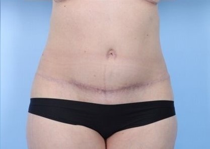 After Image: Patient 1 - front