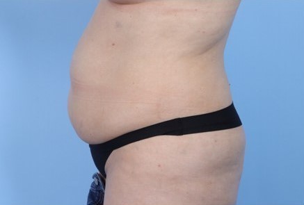Before Image: Patient 1 - left-side