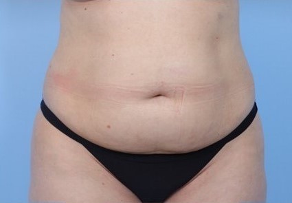 Before Image: Patient 1 - front