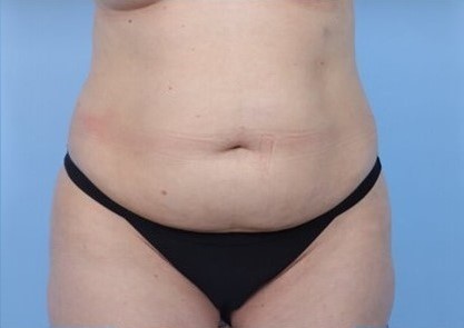 Before Image: Patient 1 - front