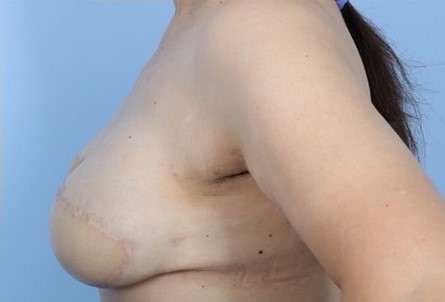 After Image: Patient 2 - left-side