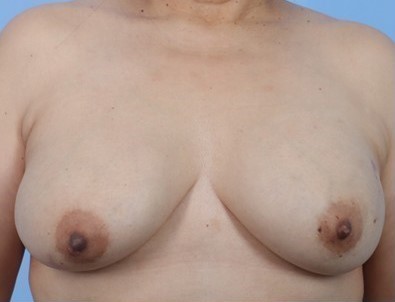 Before Image: Patient 2 - left-side