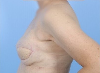 After Image: Patient 10 - left-side