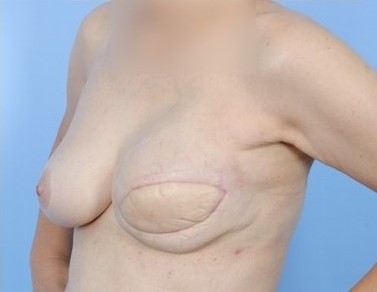 After Image: Patient 10 - left-front-oblique