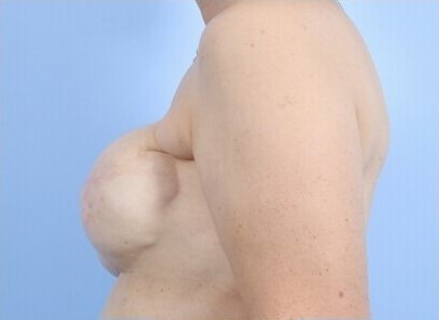 Before Image: Patient 10 - left-side