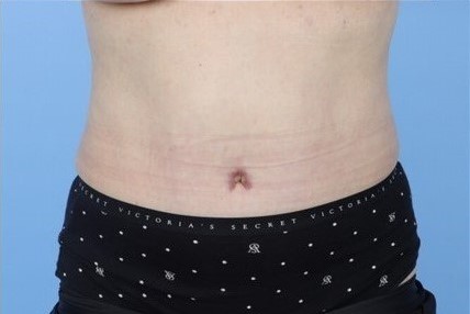 After Image: Patient 10 - front