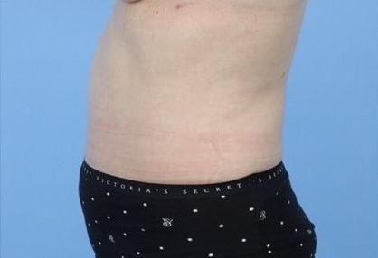 After Image: Patient 10 - left-side