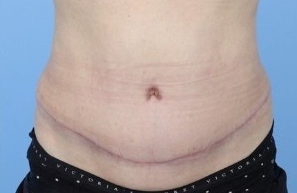 After Image: Patient 10 - front