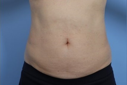 Before Image: Patient 10 - front