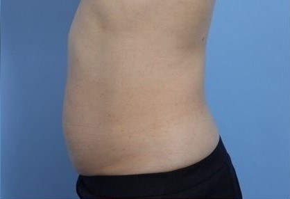 Before Image: Patient 10 - left-side