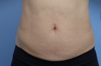Before Image: Patient 10 - front