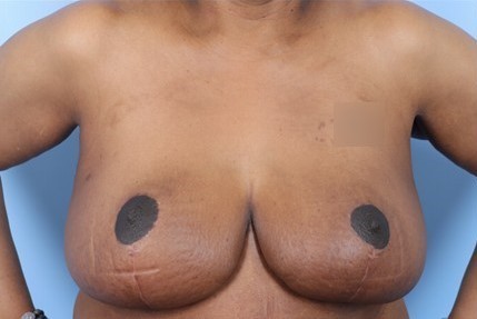 After Image: Patient 11 - front