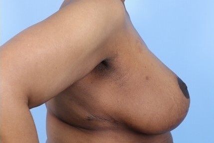 After Image: Patient 11 - right-side