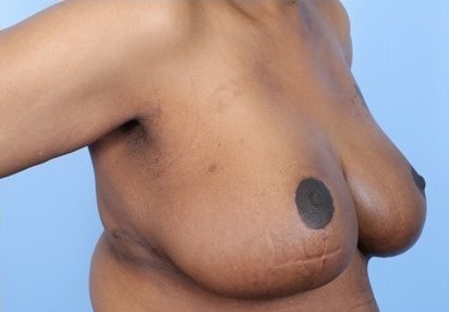 After Image: Patient 11 - right-front-oblique