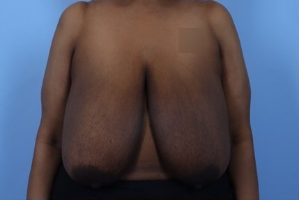 Before Image: Patient 11 - front