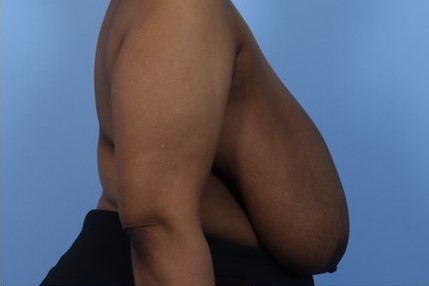 Before Image: Patient 11 - right-side