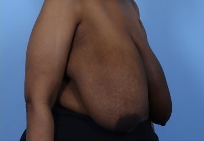 Before Image: Patient 11 - right-front-oblique