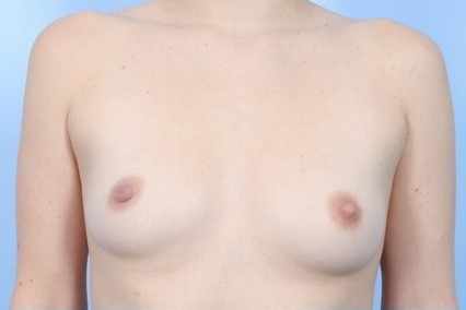 Before Image: Patient 14 - front