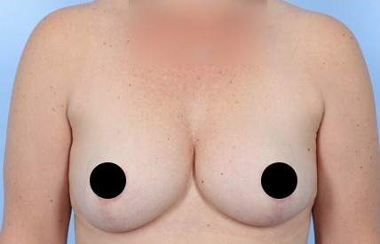 After Image: Patient 17 - front