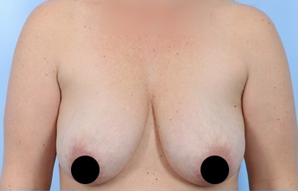 Before Image: Patient 17 - front