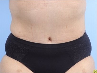 After Image: Patient 2 - front