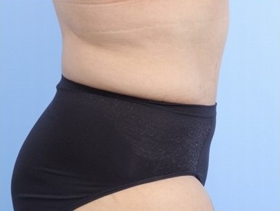 After Image: Patient 2 - right-side