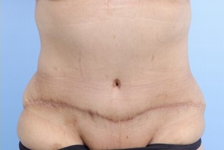 After Image: Patient 2 - front