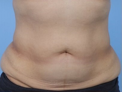 Before Image: Patient 2 - front