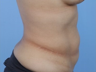Before Image: Patient 2 - right-side