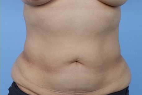 Before Image: Patient 2 - front