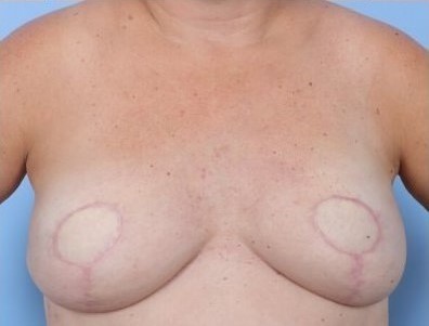 After Image: Patient 3 - front