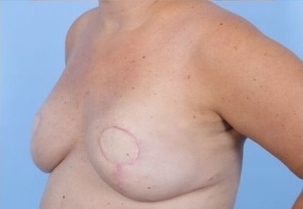 After Image: Patient 3 - left-front-oblique