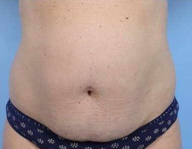 Before Image: Patient 3 - front