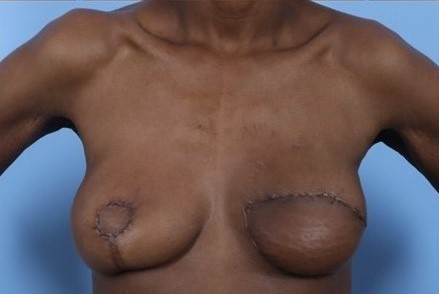 After Image: Patient 4 - front