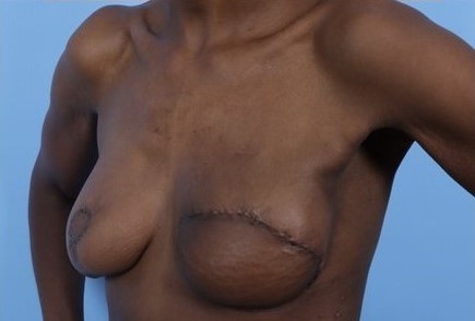 After Image: Patient 4 - left-front-oblique