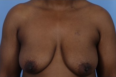 Before Image: Patient 4 - front