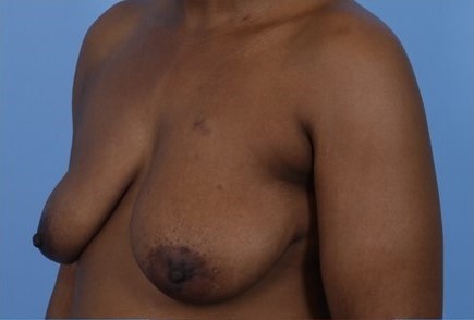 Before Image: Patient 4 - left-front-oblique
