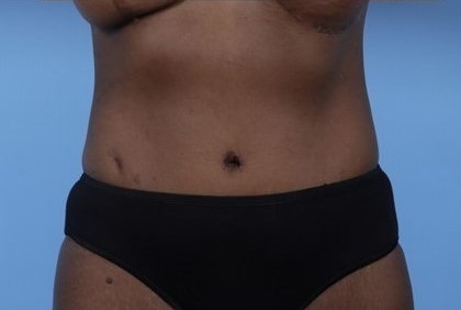 After Image: Patient 4 - front