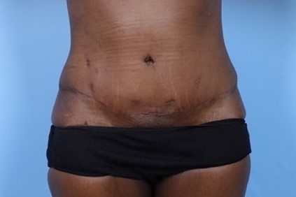 After Image: Patient 4 - front