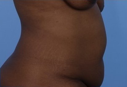 Before Image: Patient 4 - right-side