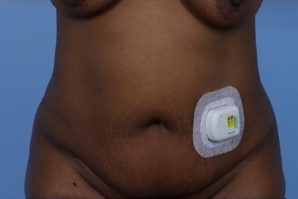 Before Image: Patient 4 - front