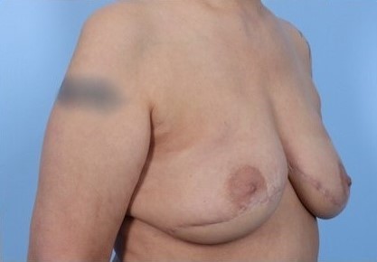 After Image: Patient 5 - right-front-oblique