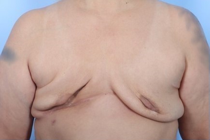 Before Image: Patient 5 - front