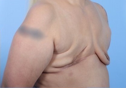 Before Image: Patient 5 - right-front-oblique