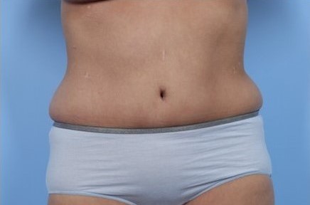After Image: Patient 5 - front