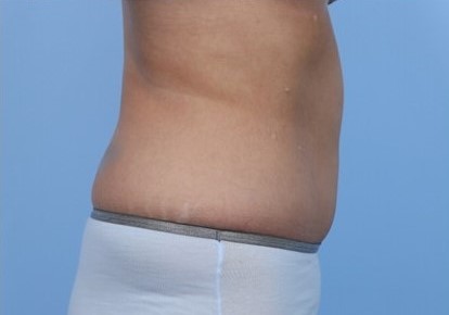 After Image: Patient 5 - right-side